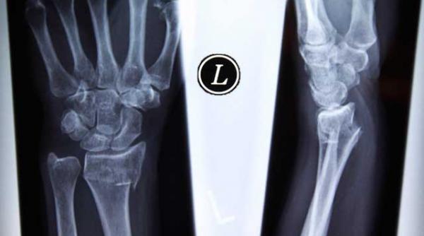 cat de mare este riscul de osteoporoza