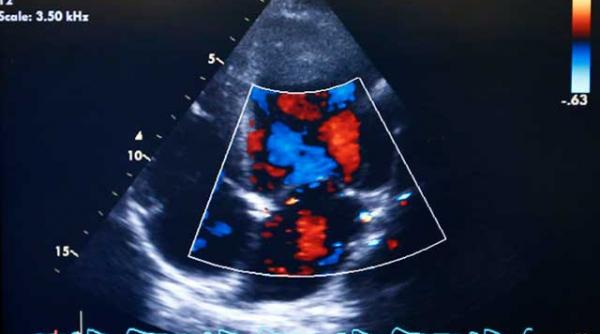 ce este histerosalpingografia