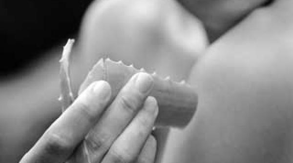 lotiuni naturale pentru calmarea arsurilor solare