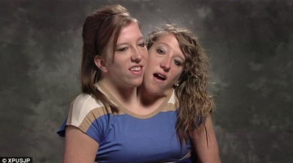 povestea extraordinara a gemenelor siameze cu un singur corp si doua capete