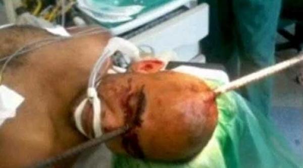 miraculos a supravietuit dupa ce o bara de metal i a strapuns craniul video