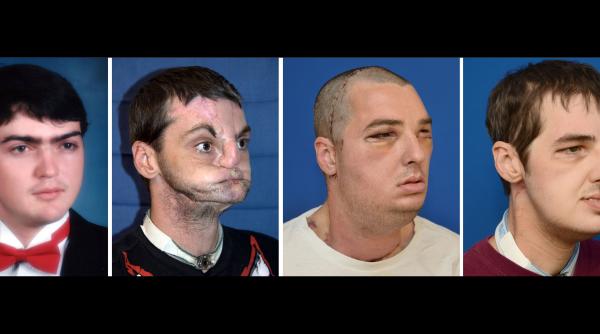 transplant de fata imagine