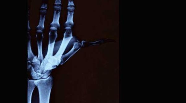 atentie la copiii cu artrita juvenila afectiune care provoaca deformari sever ale oaselor