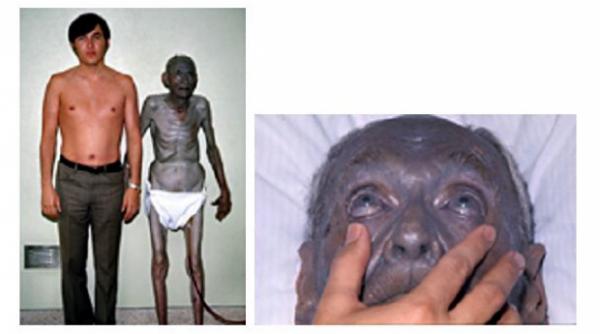 o boala rara face pielea si organele albastre este provocata de un produs gasit si in romania