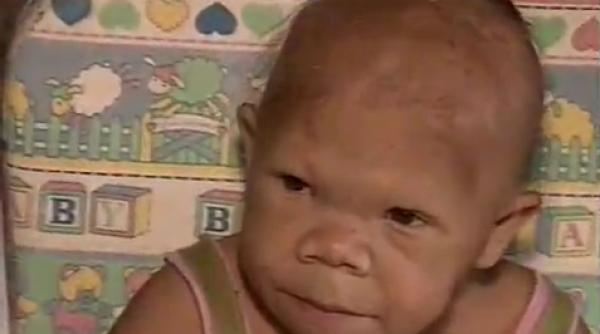 caz medical incredibil are 30 de ani dar arata ca un copil de noua luni