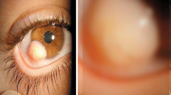 caz unic in lume medicii au ramas muti de uimire cand au vazut ce i a crescut unui tanar pe globul ocular