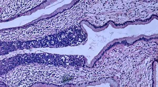 cancer de col uterin medicament tratament