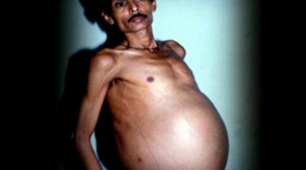 caz medical misterios ce au descoperit medicii in stomacul unui barbat