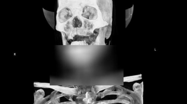 nu credeam ca o sa apuc sa vad asta ce au descoperit medicii in gatul unui pacient