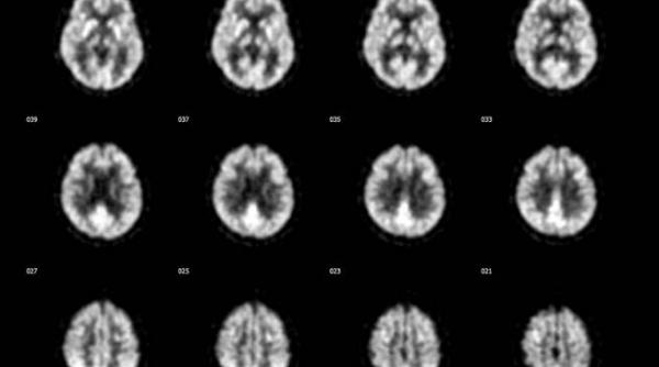 depistarea si tratamentul cancerului vor fi mai ieftine si mai accesibile romanilor
