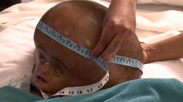 reusita extraordinara fetita cu cap de extraterestru operata cu succes cum arata acum video