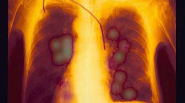 un tratament experimental permite prelungirea vietii in cazul bolnavilor de cancer pulmonar in faza avansata