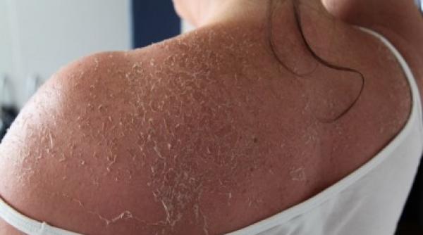 ce sa faci cand ti se jupoaie pielea de la soare