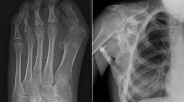 boala chinuitoare adolescenta se transforma treptat