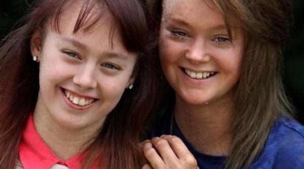 se intampla o data la 600 000 de oameni doua surori din marea britanie pierd 25 de kg de piele in fiecare an