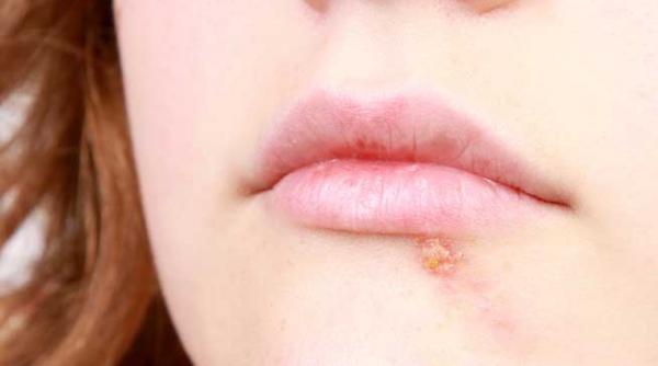 soarele si herpesul expunerea prelungita la razele ultraviolete favorizeaza revenirea herpesului