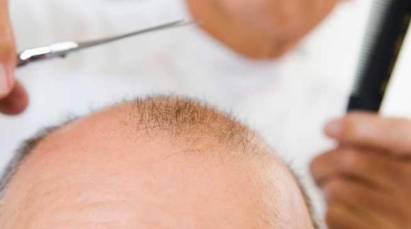 un tratament contra calvitiei