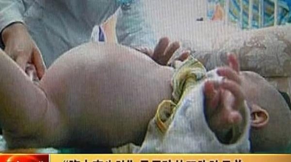 caz medical incredibil in china un baietel de doi ani si a nascut fratele geaman video