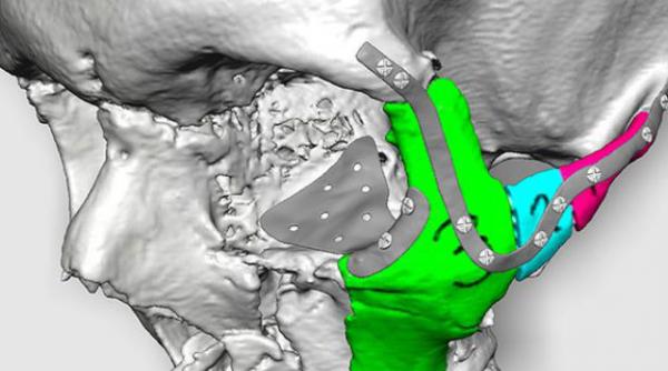 fata zdrobita a unui barbat va fi reconstruita cu ajutorul unei imprimante 3d