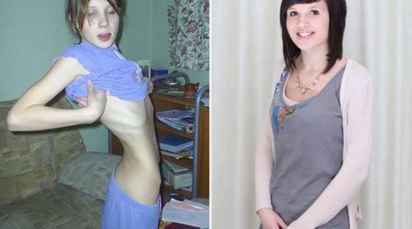 o anorexica de 25 de kilograme spune ca si a salvat viata angajandu se la mcdonald s