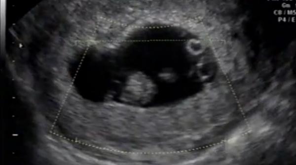 se intampla o data la 100 de milioane de nasteri ce a nascut o femeie din california a uluit medicii video