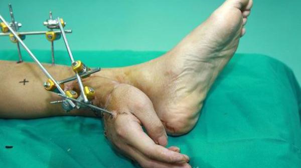 medicii i au atasat mana de glezna piciorului