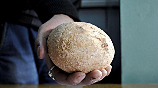 piatra la rinichi de aproape un kilogram scoasa dintr un pacient indian