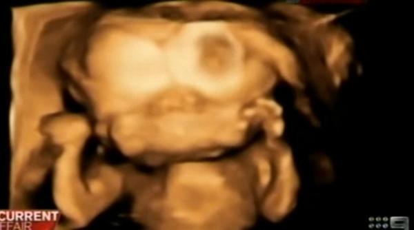 decizie incredibila ce au hotarat doi tineri dupa ce au aflat ca vor fi parintii unui copil cu doua fete si doua creiere video