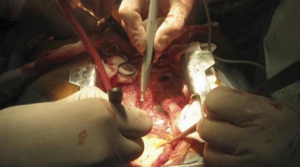 dupa 60 de zile de la implantarea bioprotezei barbatul cu inima artificiala e bine