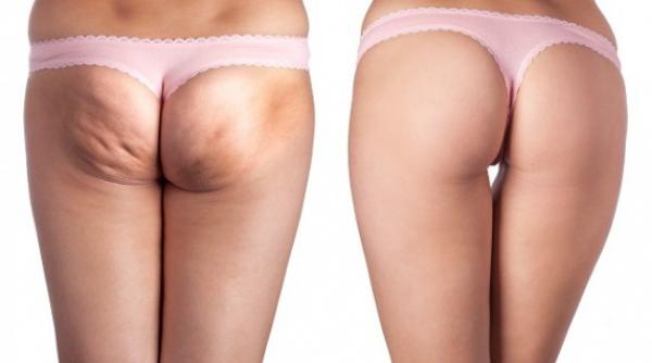 cura de ceapa in tratarea celulitei