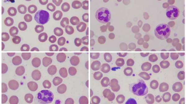 www mycmllife eu ro un site pentru pacientii cu leucemie