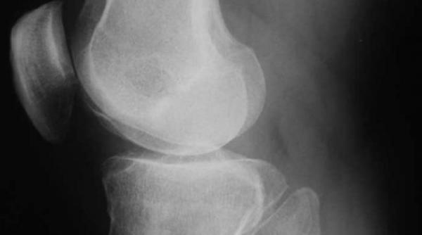 artroza boala articulatiilor cu dureri