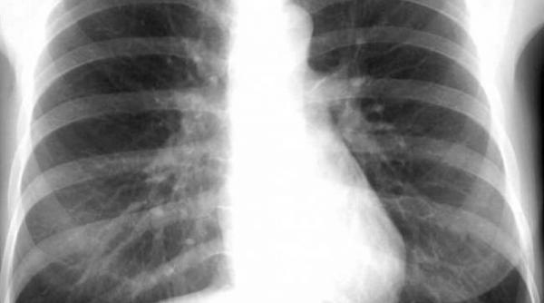 sute de copii din constanta examinati medical dupa ce un profesor de inot a fost diagnosticat cu tbc