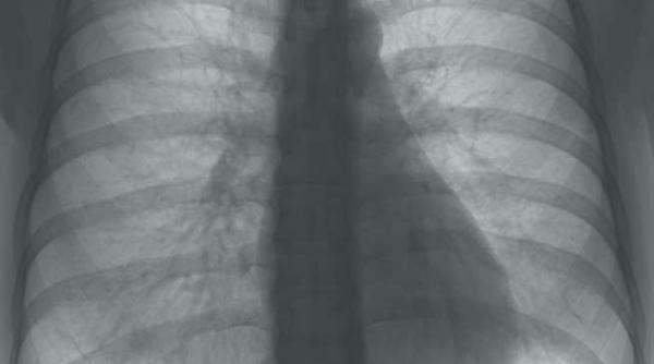 halena arata bolile plamanului compusii din aerul expirat pot indica daca o persoana sufera de cancer pulmonar