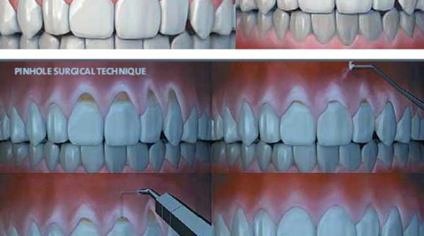 premiera in romania regenerarea gingivala minim invaziva