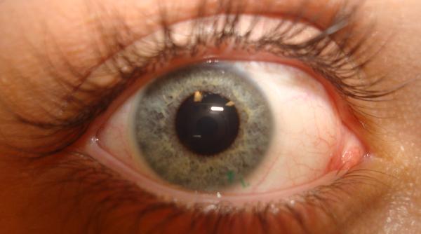 lentile contact greseala orbire