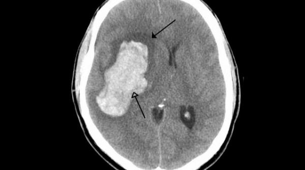 stimularea cerebrala contribuie la recuperarea dupa un accident vascular cerebral studiu