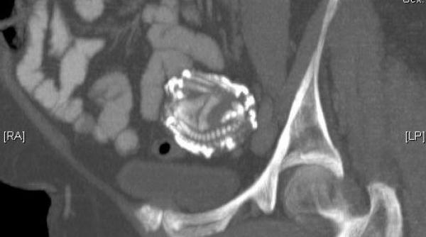 dupa 38 de ani i a fost extras scheletul copilului nenascut