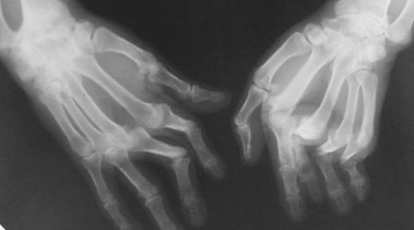 ce este poliartrita reumatoida si care sunt simptomele