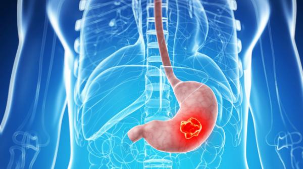 cancer gastric la 18 ani prof dr mircea beuran intr un procent mare descoperim boala canceroasa gastrica in stadiile 3 si 4