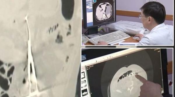 12 ani de durere din cauza chirurgilor care au uitat echipament medical in stomacul sau foto