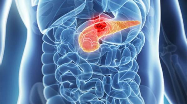 virusul care ucide cancerul cercetatorii francezi au pus la punct o terapie contra tumorilor pancreatice