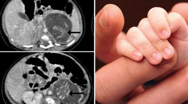 caz unic china fetita insarcinata gemeni