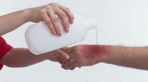 arsura tratata cu apa rece