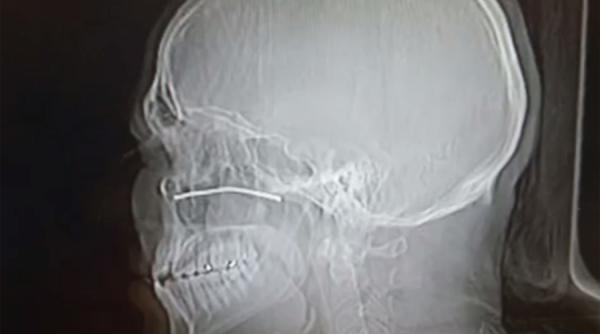 un barbat a supravietuit dupa ce o bucata de metal i a intrat in cap