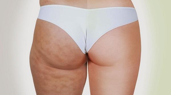 4 trucuri ca sa lupti eficient cu celulita