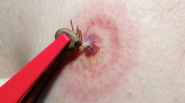 boala cu 1000 de fete ataca din nou atentie la muscatura de capuse cum se poate preveni si trata boala lyme