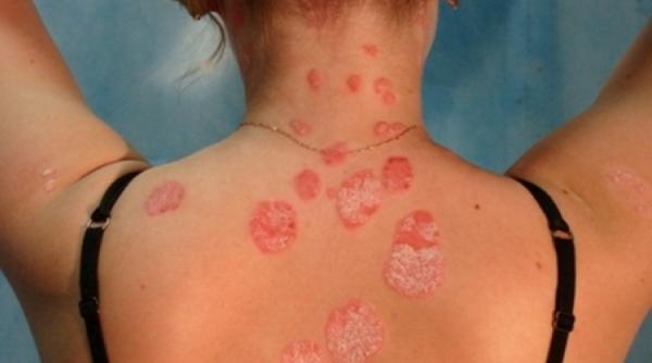 psoriazisul ce trebuie sa stii cum te protejezi pe timpul verii