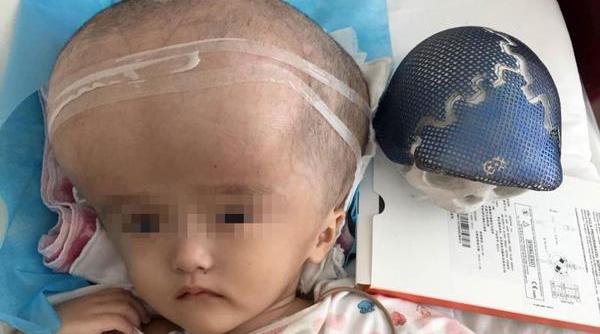 premiera medicala mondiala transplant de cutie craniana cu ajutorul unei imprimante 3 d