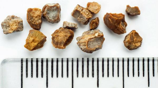 cele mai puternice ceaiuri naturale care te ajuta sa elimini usor pietrele la rinichi